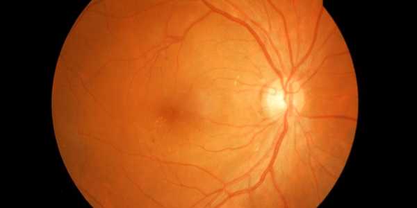 Retinal eye vein blockage