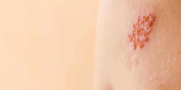 Preventing Shingles